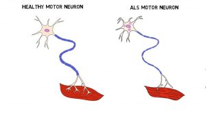 Amyotrophic Lateral Sclerosis - Getinfolist.com